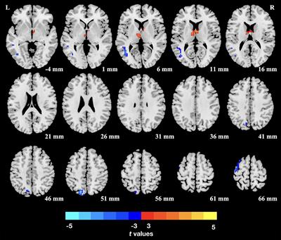 Alterations of Dynamic Regional Homogeneity in Trigeminal Neuralgia: A Resting-State fMRI Study